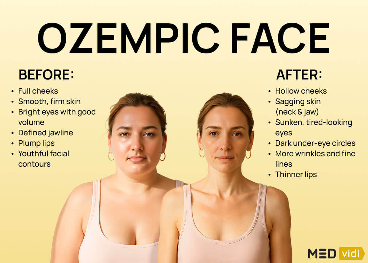 Ozempic face before and after